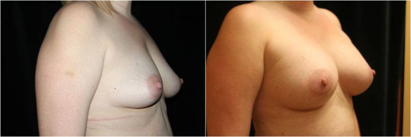 038_breast-augmentation-1-2