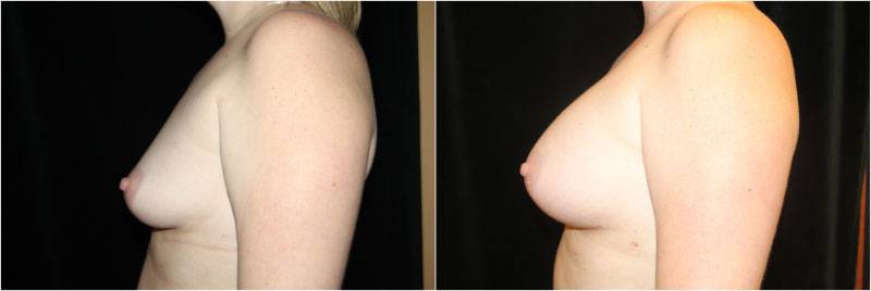041_breast-augmentation-1-5