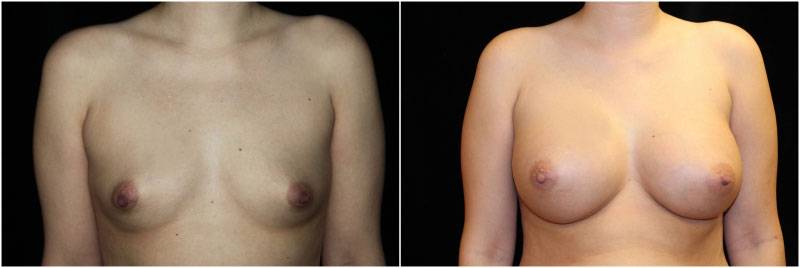 042_breast-augmentation2-1