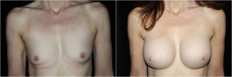 045_breast-augmentation1-1
