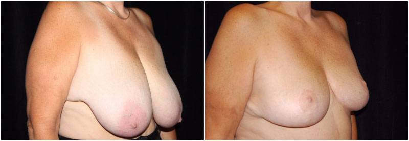 013_breast-reduction-p1-1