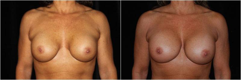 001_breast-revision1-1