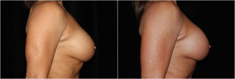 004_breast-revision1-4