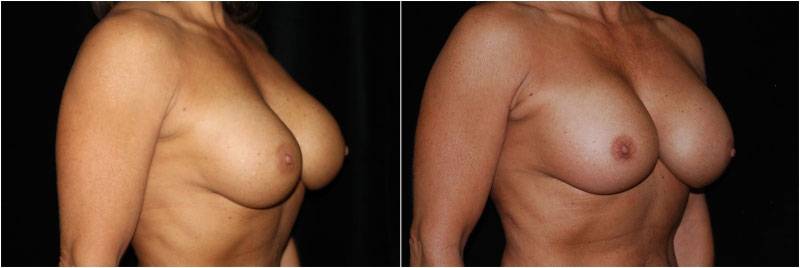 005_breast-revision1-5