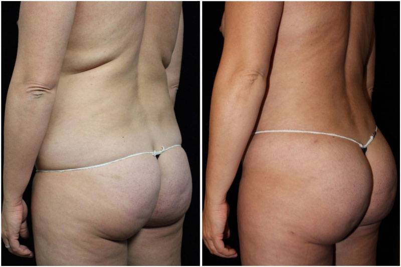 033_hm-gowda-liposuction-fat-graft-buttocks-p-10-1