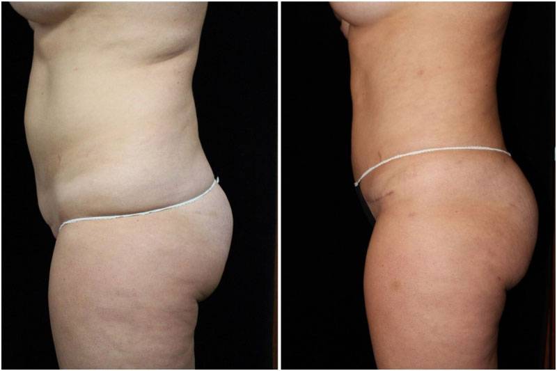 034_hm-gowda-liposuction-fat-graft-buttocks-p-10-2