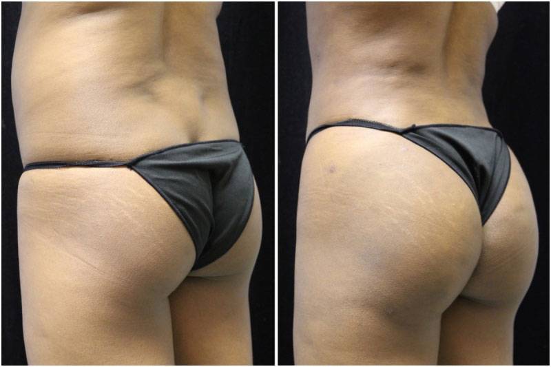 036_jn-gowda-liposuction-fat-graft-buttocks-p-11-1