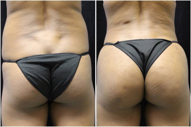 037_jn-gowda-liposuction-fat-graft-buttocks-p-11-2
