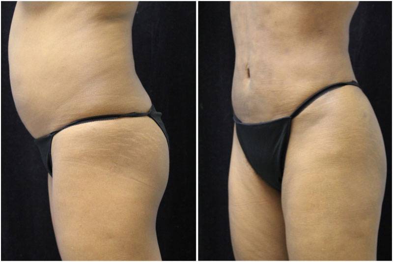 039_jn-gowda-liposuction-fat-graft-buttocks-p-11-4