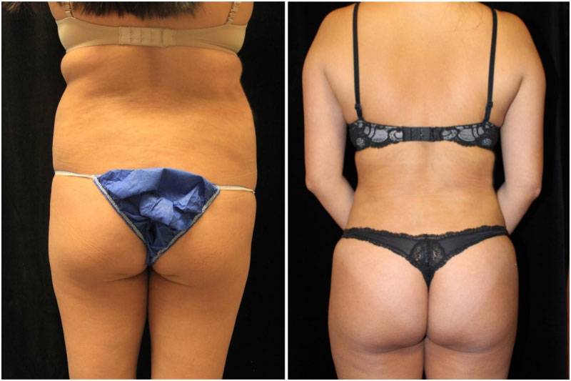 040_js-gowda-liposuction-fat-graft-buttocks-p-12-1
