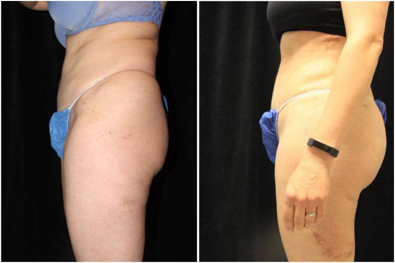 016_km-gowda-liposuction-fat-graft-buttocks-p-13-2