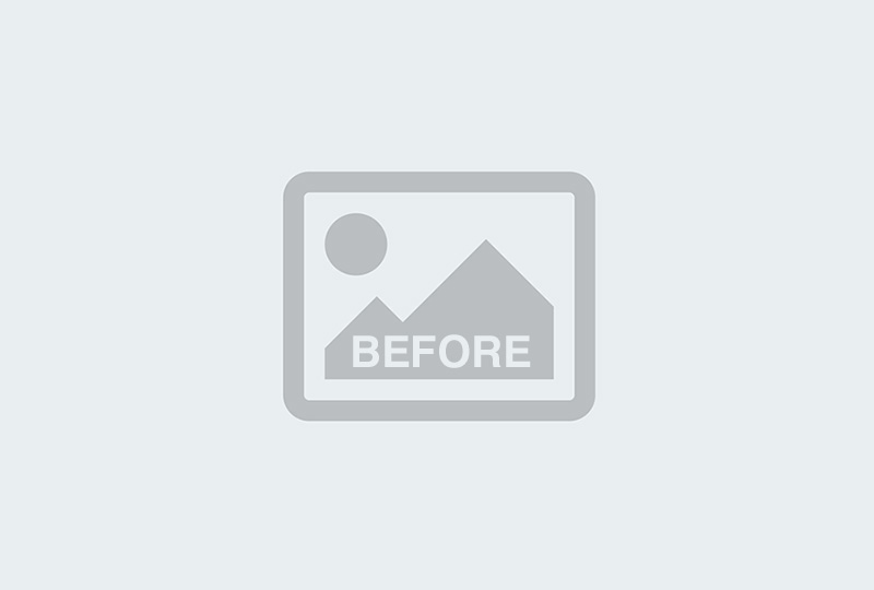 Before Image: Neck Lift - 