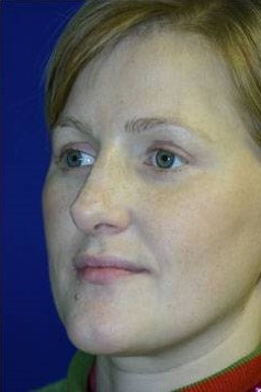 After Image: Eyelid Lift - left-front-oblique