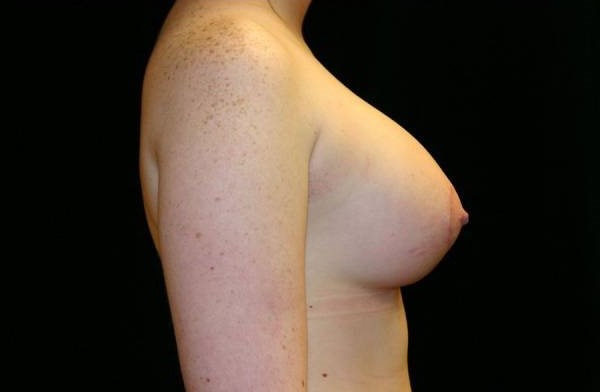 After Image: Breast Augmentation - right-side