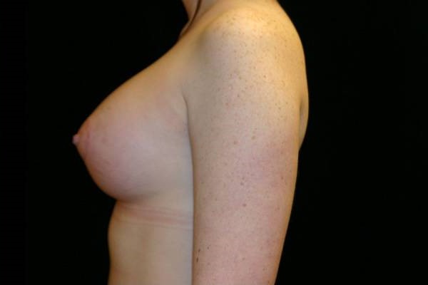 After Image: Breast Augmentation - left-side