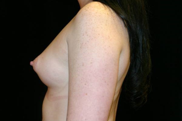 Before Image: Breast Augmentation - left-side