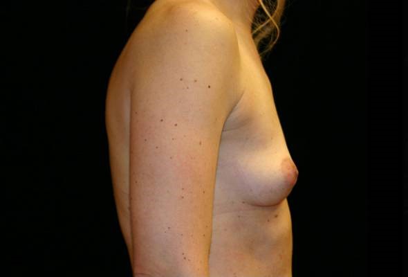 Before Image: Breast Augmentation - right-side