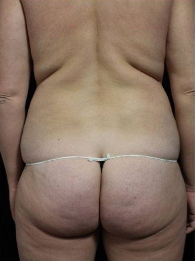 Before Image: Butt Lift - back