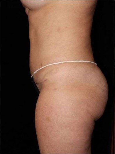 After Image: Butt Lift - left-side