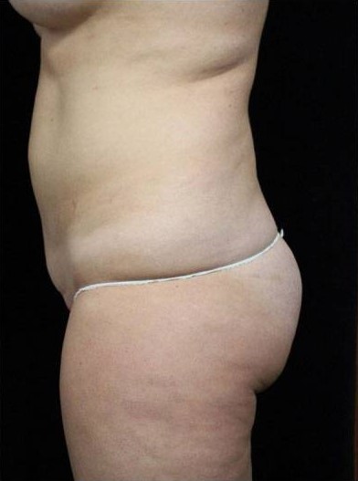Before Image: Butt Lift - left-side