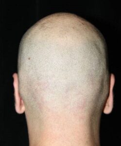 After Image: Otoplasty