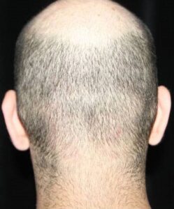 Before Image: Otoplasty