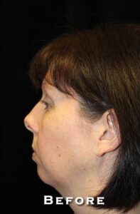 Before Image: Neck Lift