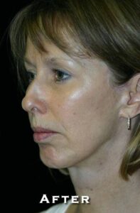 After Image: Neck Lift