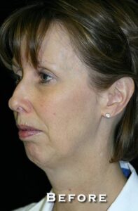 Before Image: Neck Lift