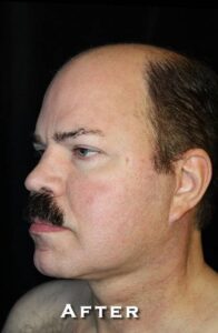 After Image: Neck Lift