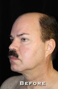 Before Image: Neck Lift