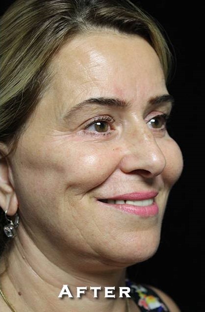After Image: Facelift - right-front-oblique