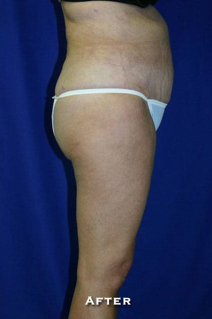 After Image: Liposuction - right-side