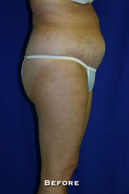 Before Image: Liposuction - right-side