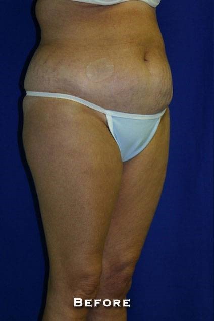 Before Image: Liposuction - right-front-oblique