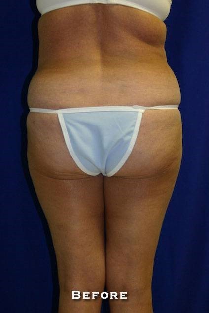 Before Image: Liposuction - back