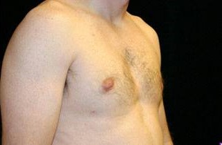 After Image: Male Breast Reduction - right-front-oblique