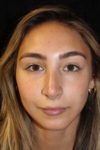 After Image: Rhinoplasty/Septoplasty