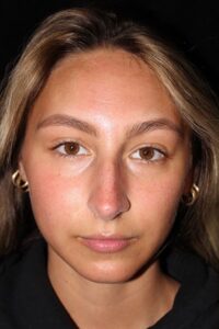 Before Image: Rhinoplasty/Septoplasty