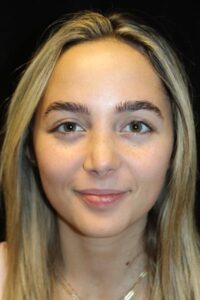 After Image: Rhinoplasty/Septoplasty