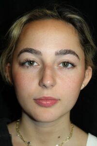 Before Image: Rhinoplasty/Septoplasty