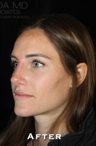 After Image: Rhinoplasty/Septoplasty