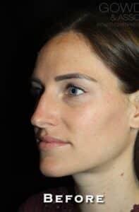 Before Image: Rhinoplasty/Septoplasty