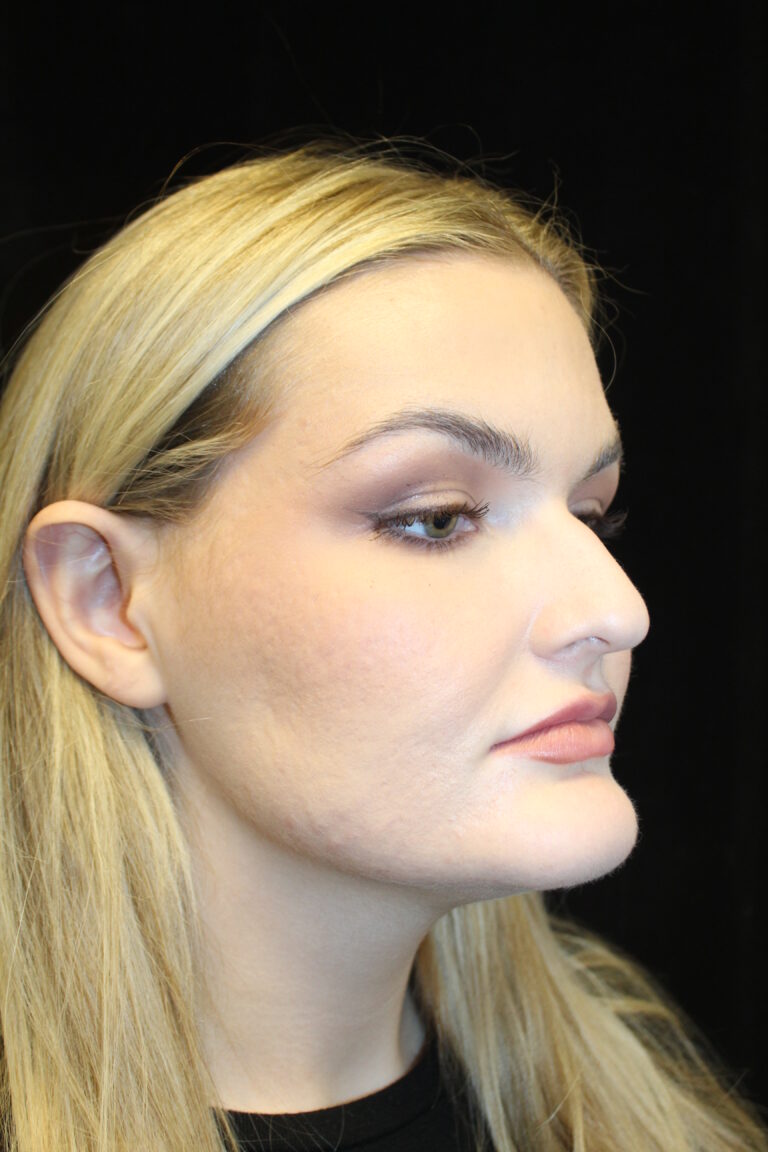 Before Image: Preservation Rhinoplasty - right-front-oblique