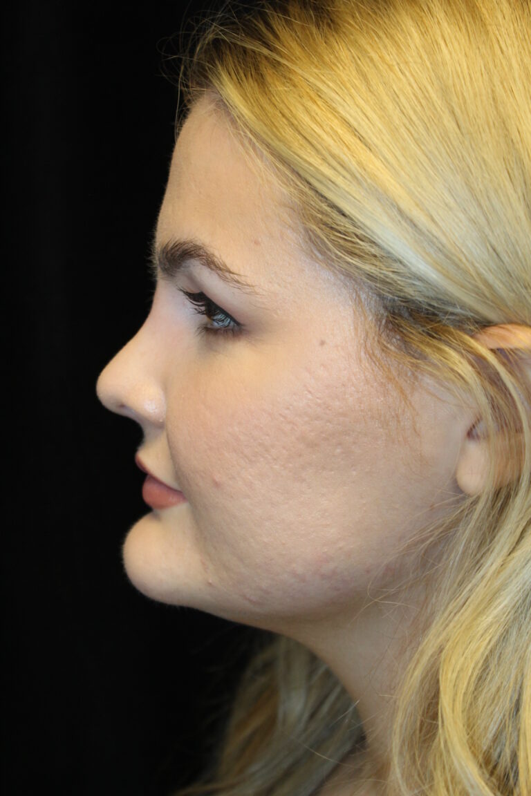 After Image: Preservation Rhinoplasty - left-side