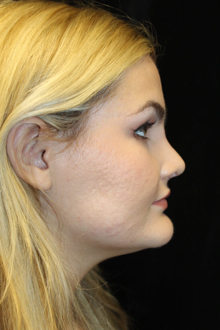 After Image: Preservation Rhinoplasty - right-side