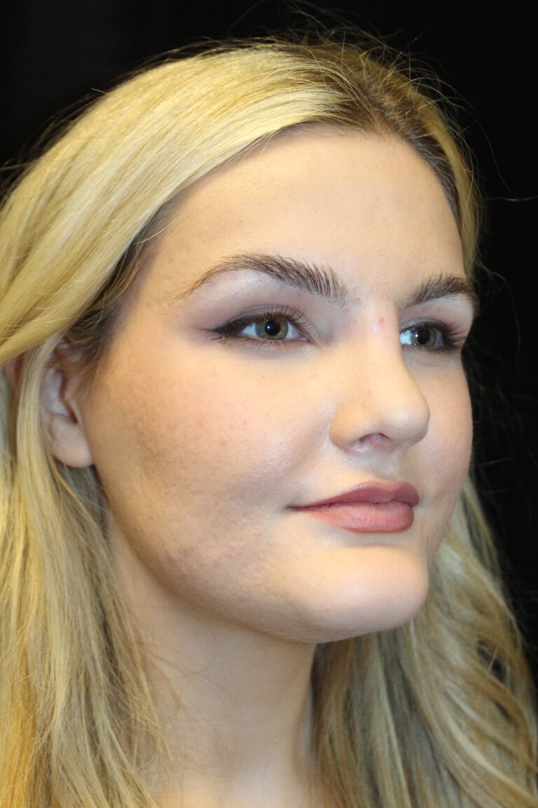 After Image: Preservation Rhinoplasty - right-front-oblique