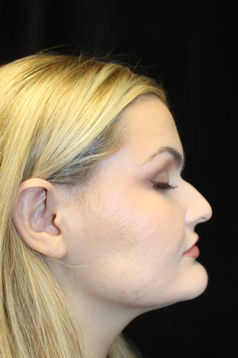 Before Image: Preservation Rhinoplasty - right-side