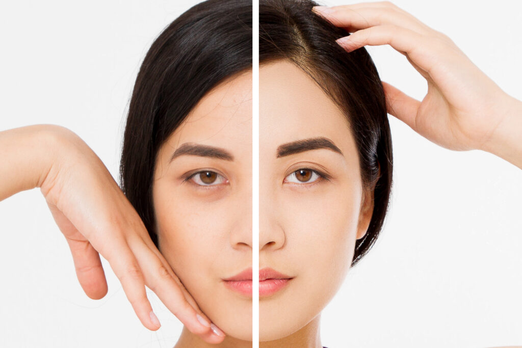 Endoscopic brow lift in Troy and Novi, MI