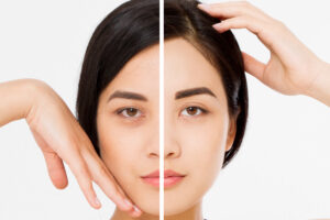 Endoscopic brow lift in Troy and Novi, MI